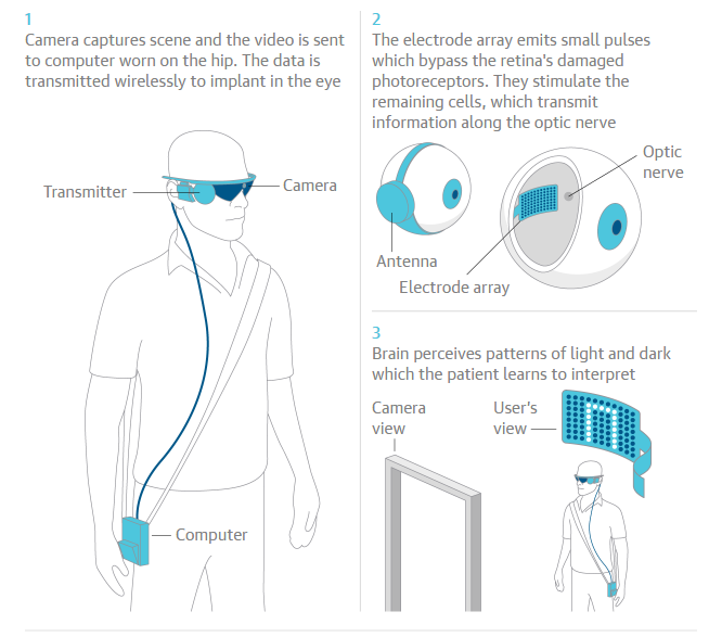 blind-nhs-patients-to-be-fitted-with-pioneering-bionic-eye-science-the-guardian